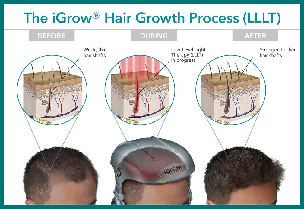 igrow Regrowth